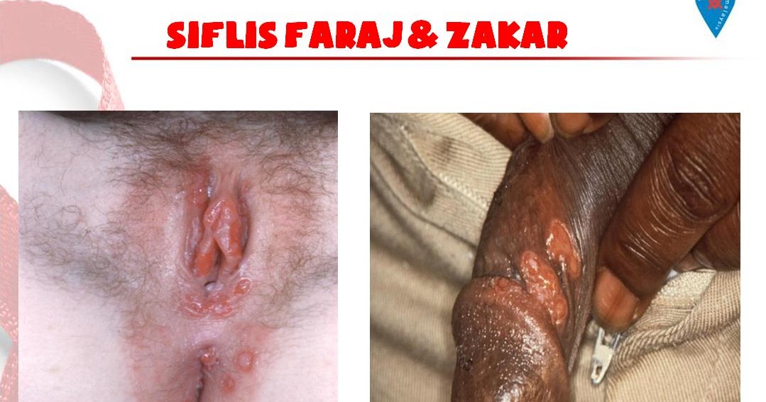 AKU HIV POSITIF: CONTOH SIFILIS FARAJ & ZAKAR