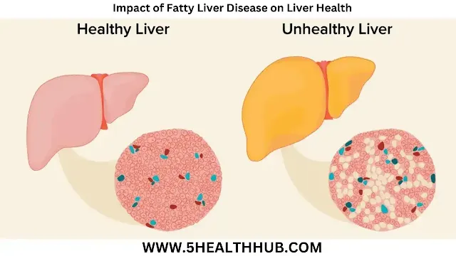 Fatty Liver Disease on Liver Health