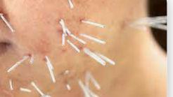 The Ancient Art of Acupuncture, A Modern Solution for Hormonal Acne.