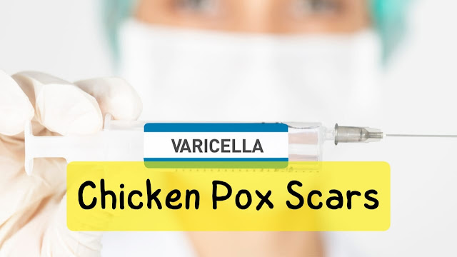 removing chicken pox scars