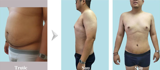 giảm mỡ bụng không phẫu thuật