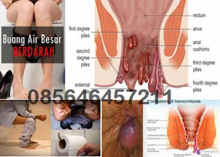 Obat Wasir Yang Cocok Buat Wanita Karier