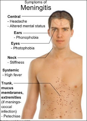 Sembuhkan Meningitis Dengan Cara Cepat