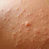 Tips menyembuhkan gatal pada kulit yang membandel