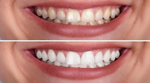 23+ Cara Memutihkan Gigi yang Sudah Kuning Secara Alami