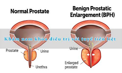 Khám nam khoa chữa trị sỏi tuyến tiền liệt -1