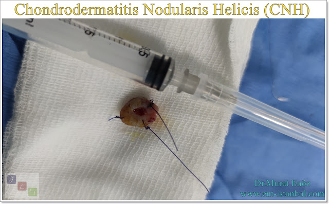 Chondrodermatitis Nodularis Helicis, CNH, Auricle lesion, Small tender nodule on the auricle