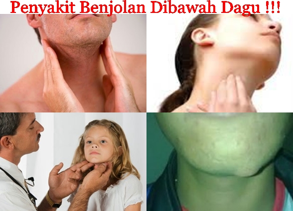 Obat Tradisional Benjolan Dibawah Dagu