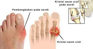 makanan penyebab asam urat, bahaya asam urat, makanan untuk penderita asam urat, pengobatan asam urat, asam urat dan kolesterol, asam urat tinggi, asam urat normal, penyebab asam urat dan cara mengatasinya,