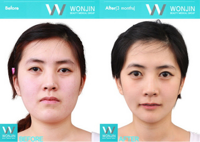 짱이뻐! - Before and After Photos Korean Face Contouring