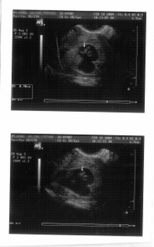 miscarriage at 7 weeks. miscarriage at 7 weeks.