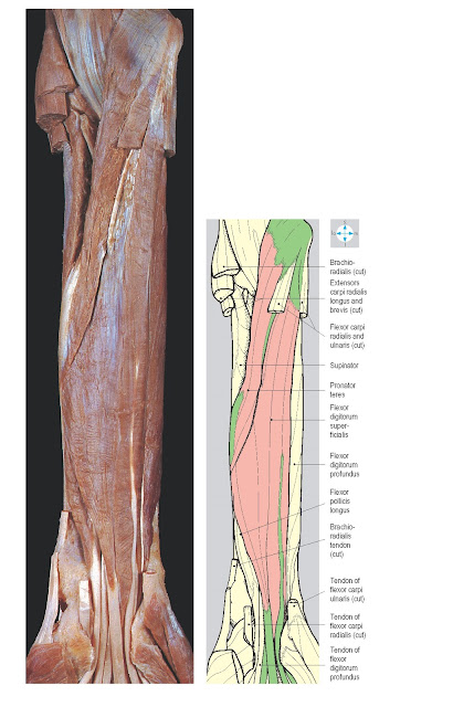 Fig. 3.32 Flexor digitorum superficialis and pronator teres, revealed by division of flexors carpi ulnaris and radialis, and of brachioradialis. The vessels and nerves in the forearm have been removed.