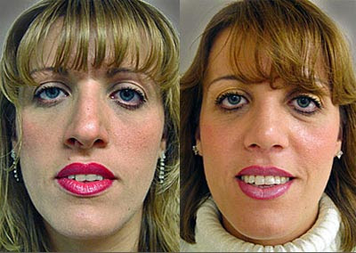 Rhinoplasty Picture