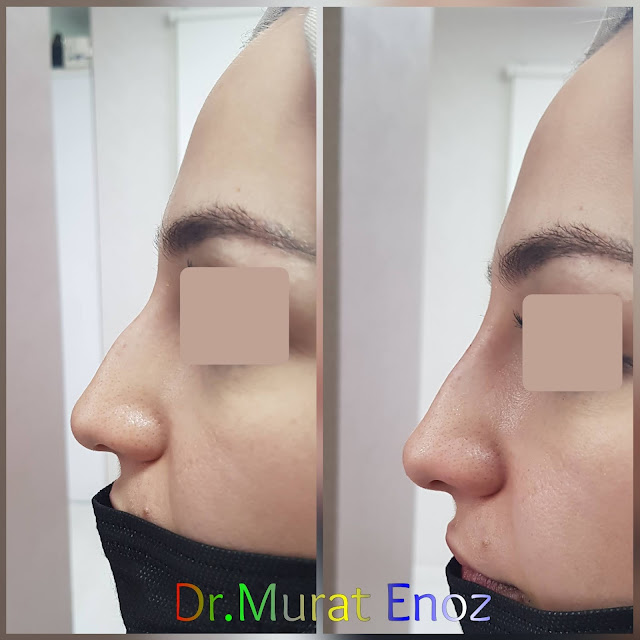 Non-surgical rhinoplasty with filler istanbul