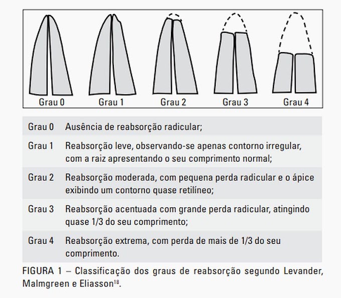 PDF: Estudo comparativo da reabsorção radicular apical em pacientes bruxônomos e pacientes sem sinais clínicos de desgaste dentário