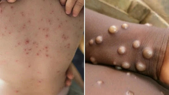 Monkeypox emergency could last months with window closing to stop spread - scientists say