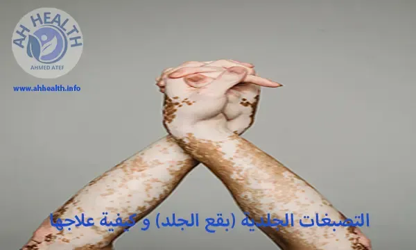 التصبغات الجلدية (بقع الجلد) و كيفية علاجها