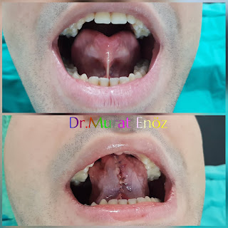 Tongue Tie Release Operation in Adults