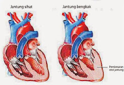 obat herbal jantung bengkak