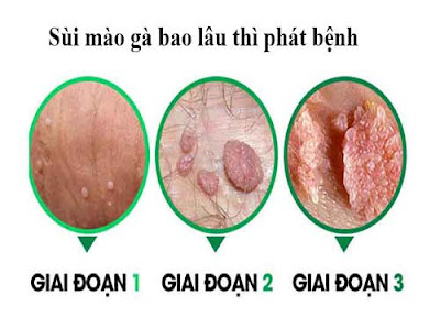 sùi mào gà bao lâu thì phát bệnh