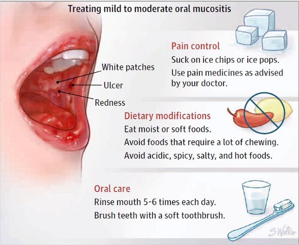 Oral Mucositis