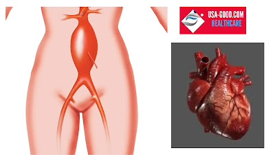 What Is Abdominal aortic aneurysm (AAA)?