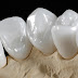 Bọc răng sứ cercon diễn ra như thế nào? 