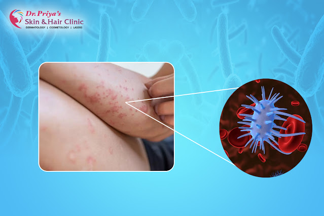 Best Bacterial Infection Treatment in Marathahalli