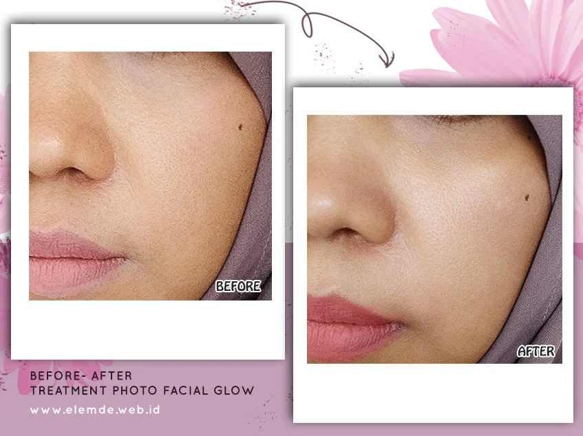 Photo Facial Glow