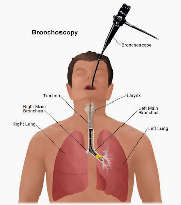 fibroscopie bronchique pulmonaire infirmier