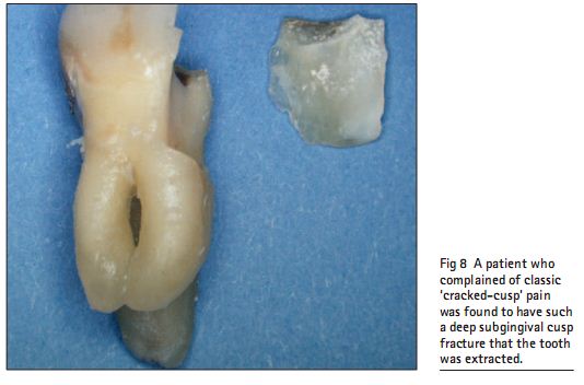Fig 8  A patient who complained of classic  cracked-cusp  pain was found to have such a deep subgingival cusp fracture that the tooth was extracted.