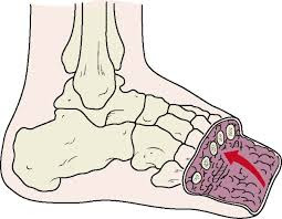 Transmetatarsal amputation Pictures, Rehabilitation, Recovery, Prosthesis