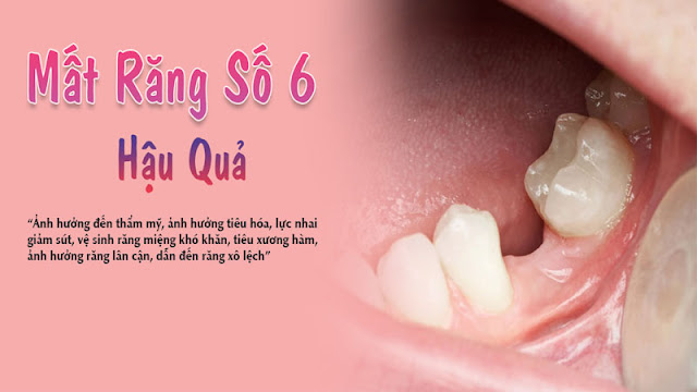 Hậu quả của mất răng số 6 sớm và cách khắc phục sau khi mất răng