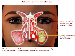 pengobatan alternatif radang sinusitis