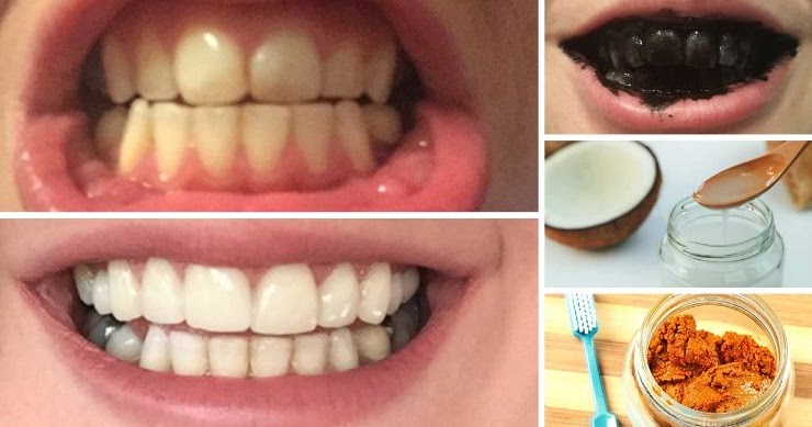 Home Remedies for Teeth Whitening