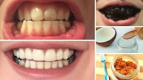 Home Remedies for Teeth Whitening