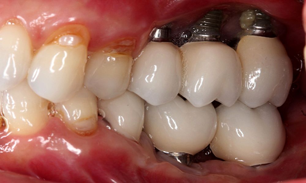 Implantes Dentales