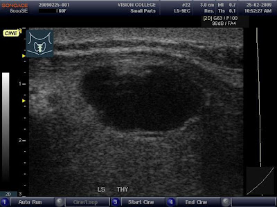 Nodules On Thyroid