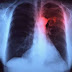 Embolia pulmonar - Síntomas y causas