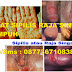 Obat Herbal Sifilis