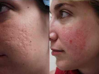 Natural acne scar treatment