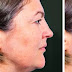 Best Plastic Surgeons in Dubai for Profhilo Top Clinics to Trust