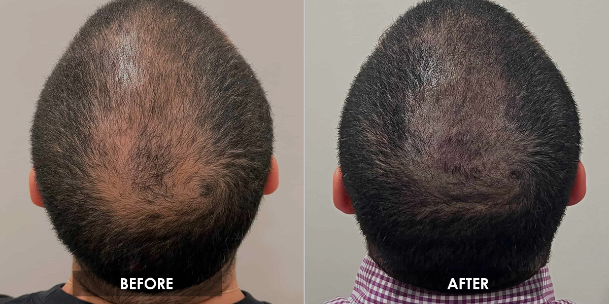 micro-pigmentation-dallas-tx