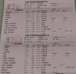 How to Manage Relapsing Nephrotic Syndrome