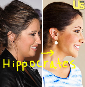 Bristol Palin Plastic Surgery Before and After Facelift ...