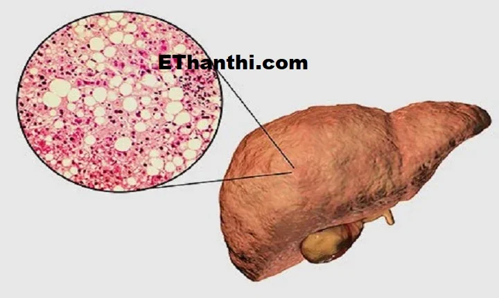 கல்லீரலில் கொழுப்பு படிதலும்... அதற்கான மூல காரணங்களும் !