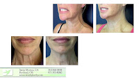 Best Non Surgical Neck Lift