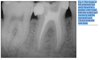 Fig. 1  The shape of the prepared root canal should be a gradual, even taper, with the widest part coronally and the narrowest part 1.0 mm from the root apex.