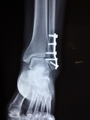 ankle fracture causes symptoms treatment