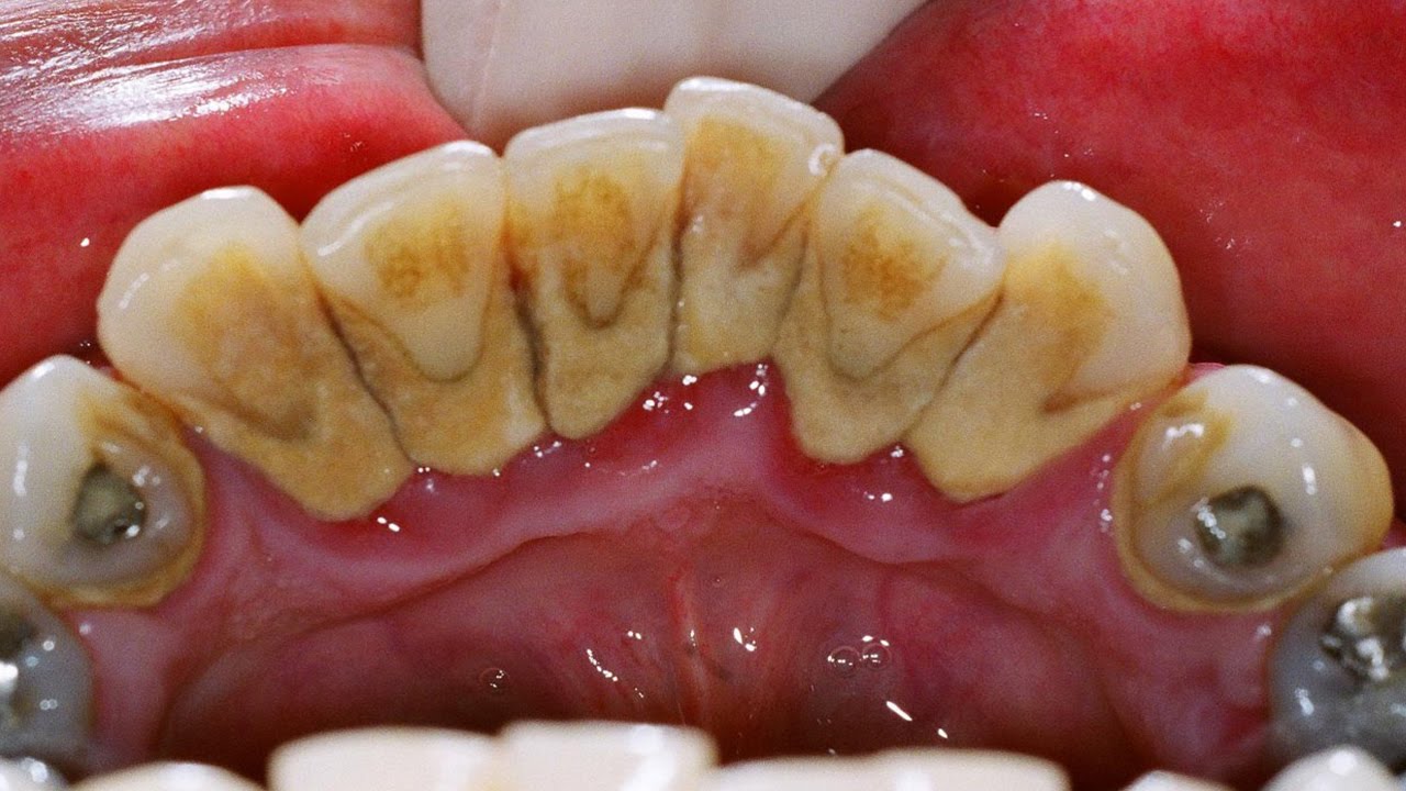 NATURAL TREATMENT You Have Tartar On Your Teeth? Remove